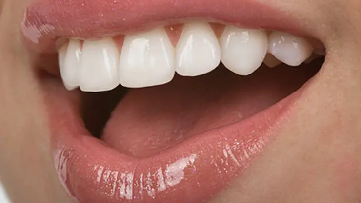 Veneer / Verblendschale