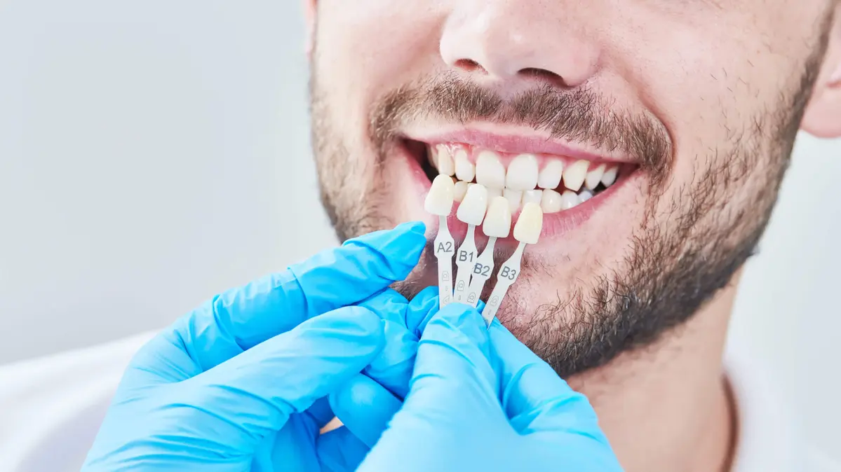 Patient werden Farbmuster für Veneers / Verblendschalen an die Zähne gehalten
